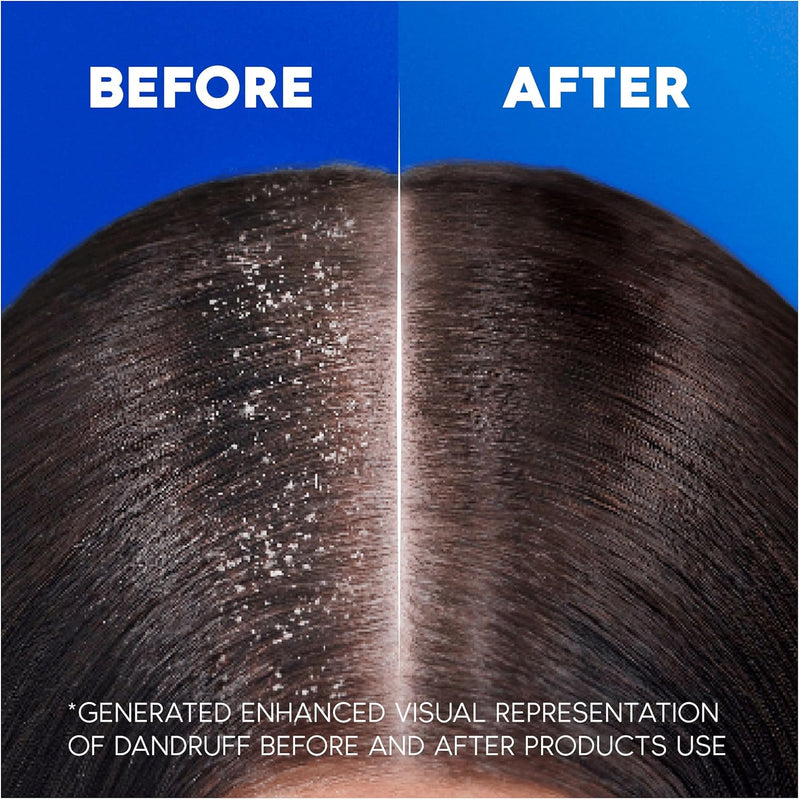 Head & Shoulders Classic Clean 2in1 Anti Dandruff Shampoo, 1000ml. Up to 100% Flake Free, Clinically Proven. For Any Hair and Scalp Type. For Daily use. Clean Feeling